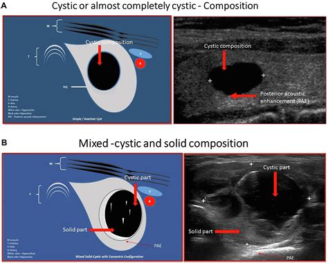 American Association Of Clinical Endocrinology And Associazione Medici Endocrinologi Thyroid