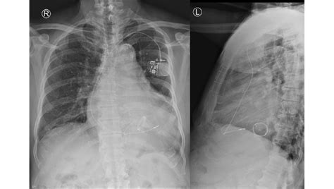 Chest X Ray Tissue Mitral Valve Replacement Carpentier Edwards