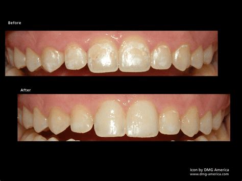 What Are The White Spots On Teeth And How Can You Treat Them