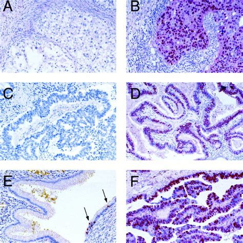 Examples Of Immunohistochemical Staining Patterns Of Er A B Pr C