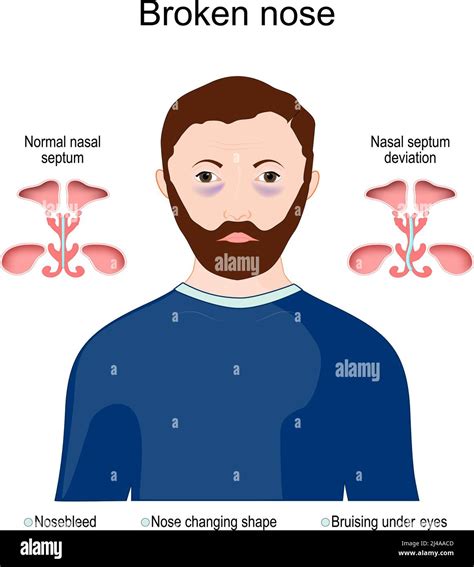 Nose Cartilage Diagram