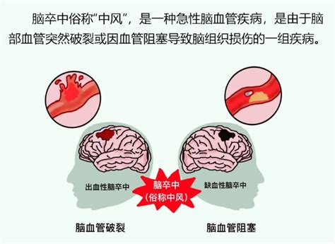 脑卒中患者如何进行快速急救处理？ Medscicn