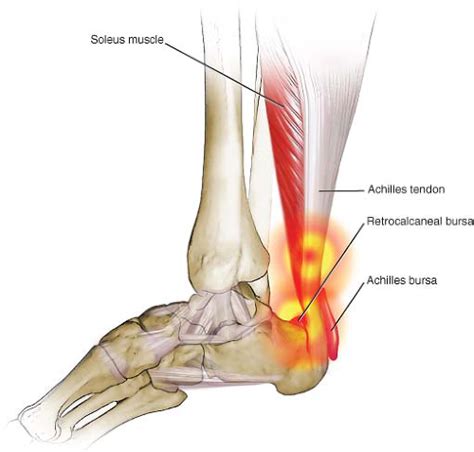 Achilles Tendinitis And Other Abnormalities Of The Achilles Tendon 17094 Hot Sex Picture