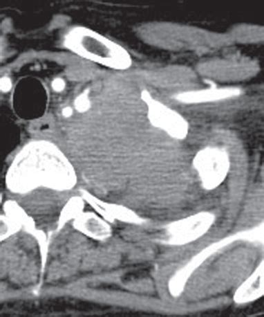 75 Pancoast Tumor: Adenocarcinoma | Radiology Key