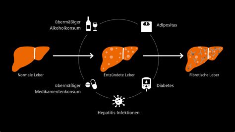 Leberkrebs Von Der Diagnose Zur Personalisierten Behandlung