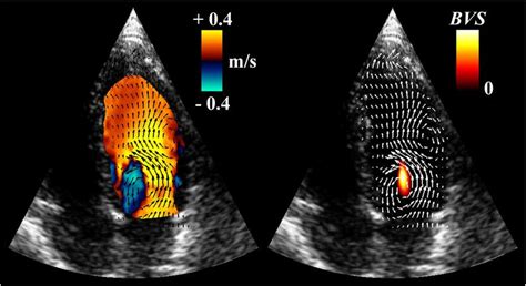 Left Doppler Field In The Left Ventricle Red Blue Color Map With The