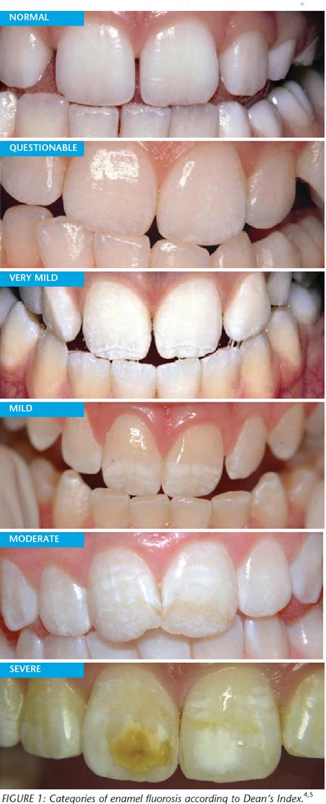 Figure From Enamel Fluorosis A Cause For Concern Semantic Scholar