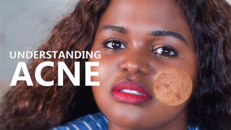 Understanding The Basics Of Acne What You Need To Know Youtube