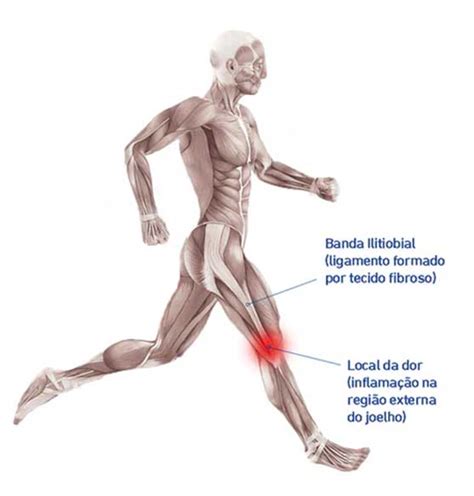 S Ndrome Da Banda Iliotibial Saiba O Que E Como Tratar Bauerfeind