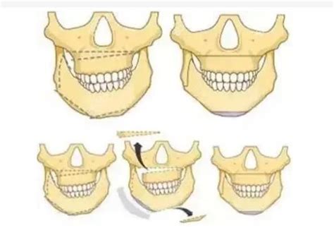 骨性偏颌做正颌手术经历 双颌消肿后样貌改变大 脸不会再歪 下巴整形 8682整形网