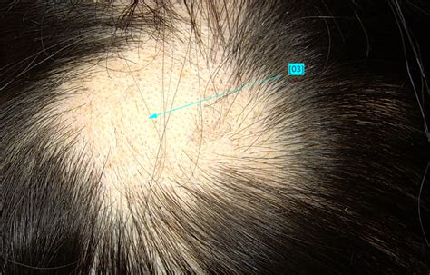 Hair transplantation in scar alopecia Doç Dr Ekrem Civas Ankara