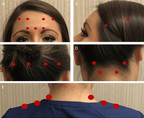 Onabotulinumtoxina 150 Units Protocol A 5 Units 1 Injection Site In Download Scientific