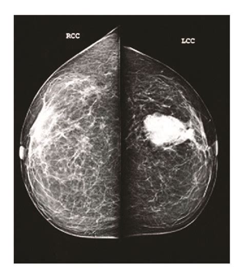 Mammography Demonstrates A Stable Oval Circumscribed Mass In The