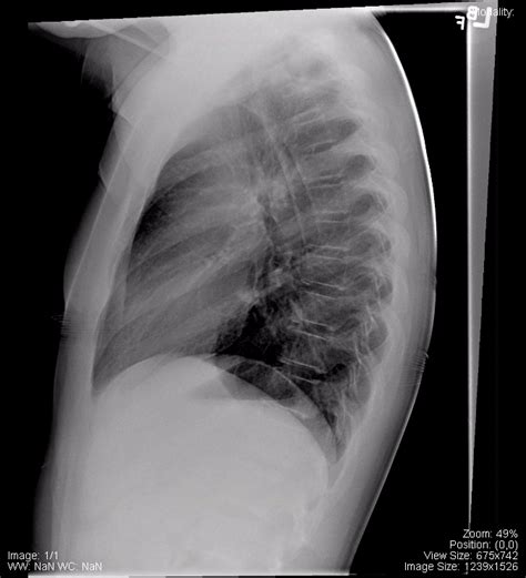 Normal Lateral Chest Radiograph