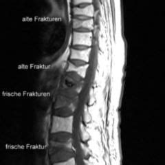 Osteoporose Doccheck Flexikon