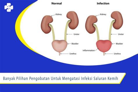 Banyak Pilihan Obat Untuk Mengatasi Infeksi Saluran Kemih