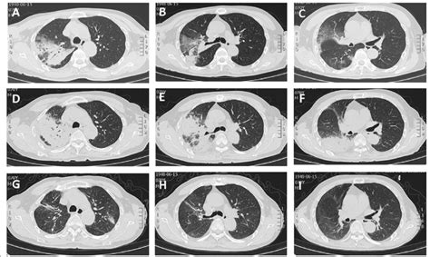 In Case 1 Ct Scan A B And C Showed Consolidation Of The Right Upper Download Scientific