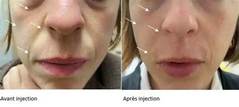 Injections D Acide Hyaluronique Pour Rajeunir Le Visage Dr Molinari