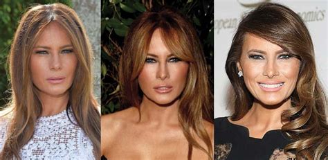 Melania Trump Plastic Surgery Before and After Pictures 2024