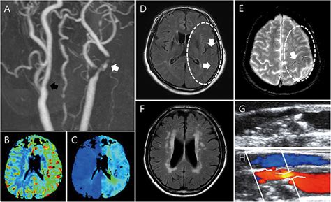 Carotid Artery Brain Prognosis