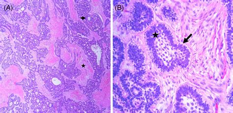 Precision Medicine Sustained Response To Erdafitinib In Fgfr2‐mutant Multiply Recurrent