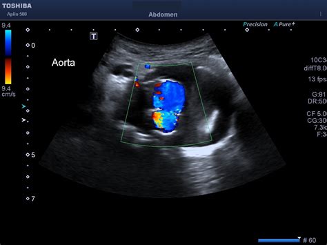 Abdominal Vascular Duplex Evaluations Abdominal Vascular Evaluations Aaa Renal Mesenteric