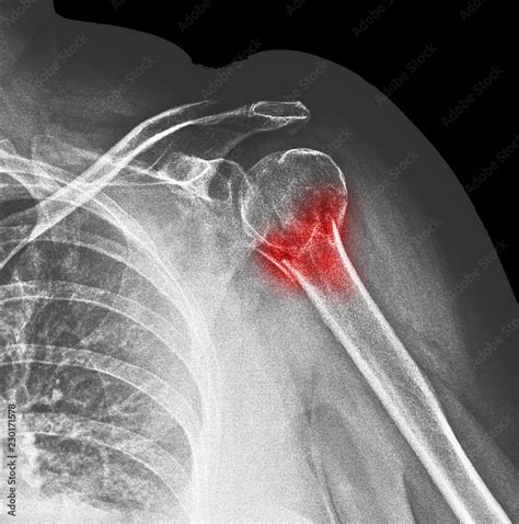 X-ray fracture of the surgical neck of the humerus Stock Photo | Adobe Stock