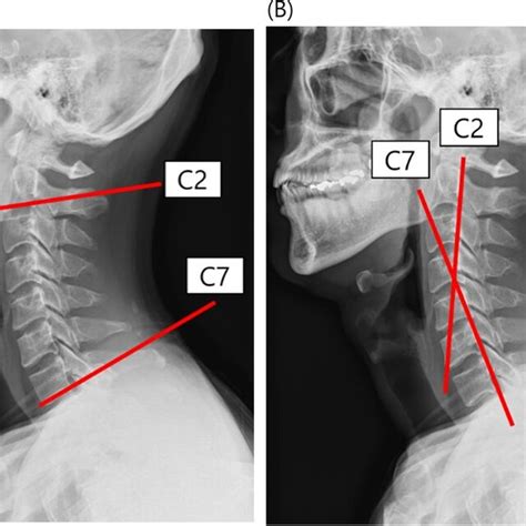 Sagittal Alignment Of The Cervical Spine Was Measured By Modified Download Scientific Diagram