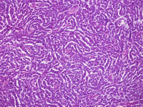 Ovarian Sex Cord Stromal Tumours And Their Mimics Pathology