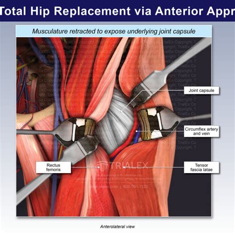 Left Total Hip Replacement Via Anterior Approach Trialexhibits Inc