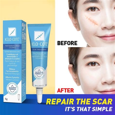 Hot Sale America KeloCote Scar Removal Cream Stretch Mark Remover