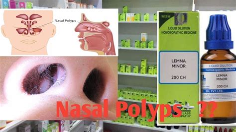 Nasal Polyps Homeopathic Medicine For Nasal Polyps Nasal Polyps Youtube