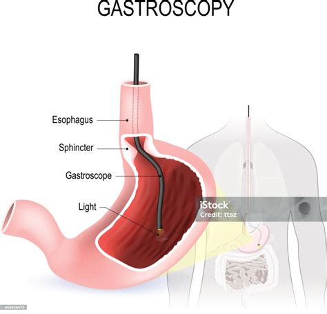 Gastroscopy Esophagoscopy And Duodenoscopy Stock Illustration