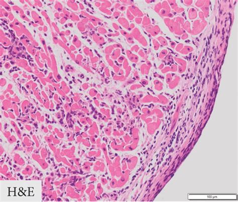 Right Ventricular Myocardial Biopsy Specimen A Extensive