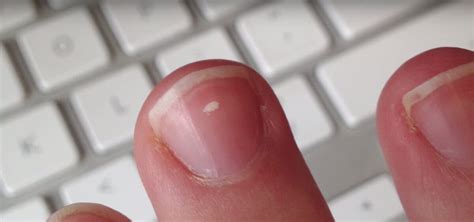 What Do Those White Marks On Your Nails Mean Thrillist