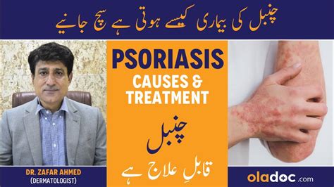 Psoriasis Skin Disease Psoriasis Kya Hai Chumbal Ka Ilaj