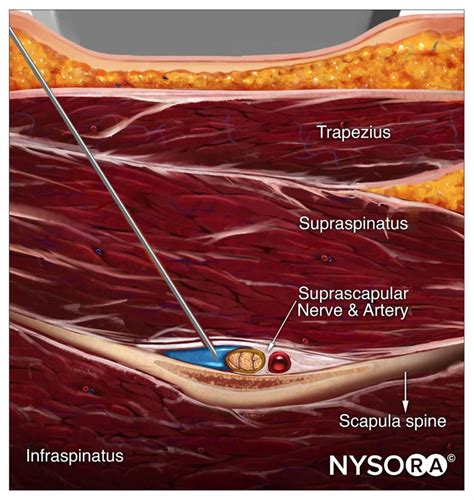 Ultrasound Pain Block Tip of the Week: Suprascapular Nerve Block ...