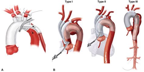 Technical Aspects Of Surgical Reconstruction For Total Aortic Arch