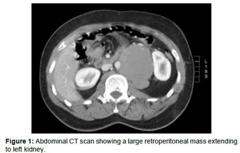 Nuclear Medicine Large Retroperitoneal Mass Extending