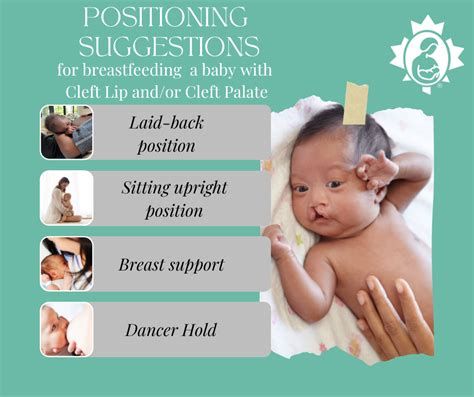 Feeding a Baby with a Cleft Lip and/or Cleft Palate | La Leche League Canada - Breastfeeding ...