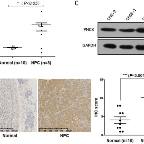 Up Regulation Of PNCK In Human NPC The Expression Of PNCK In NPC Tumor