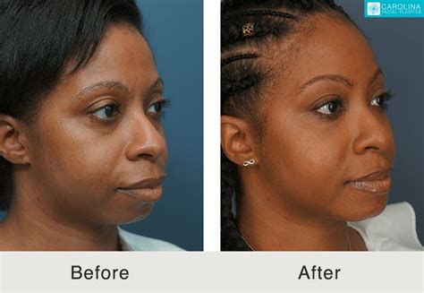 Facial Fat Transfer Charlotte Nc Carolina Facial Plastics