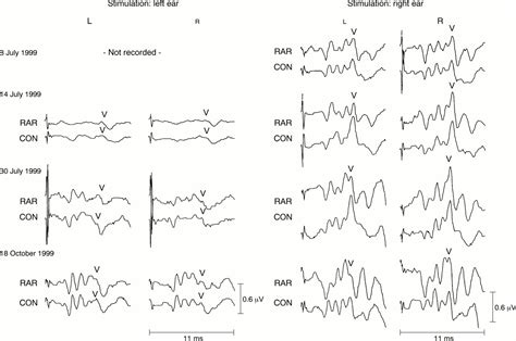 Contralateral Hearing Loss As An Effect Of Venous Congestion At The Ipsilateral Inferior