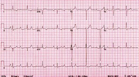 Diagnostic Tools For Arrhythmia Detection In Adults With Congenital