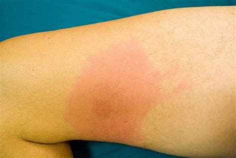 Erythema Migrans Rash Bild Kaufen Science Photo Library