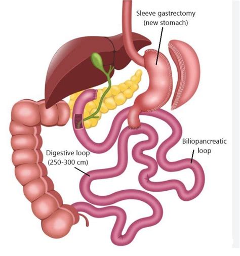 SIPS SADI LDS Versus Sleeve What S The Difference Find Surgical