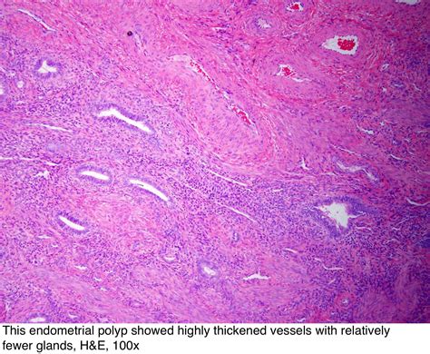 Pathology Outlines Endometrial Polyp