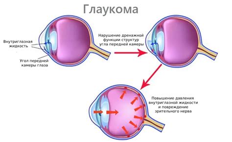 Глаукома - симптомы, признаки, лечение, диагностика
