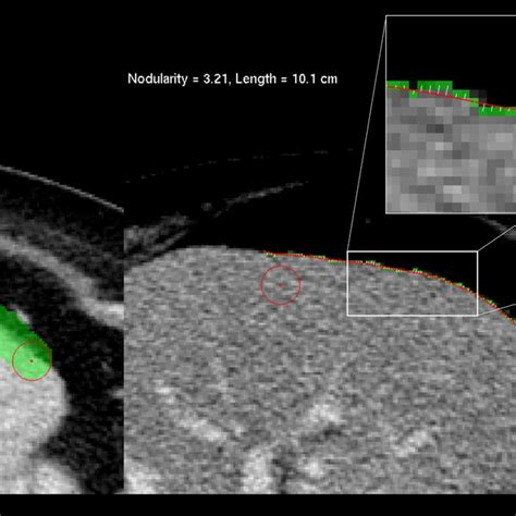 Measurement Of Liver Surface Nodularity Lsn In A Patient With Download Scientific Diagram