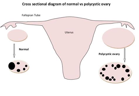 Normal Vs Polycystic Ovaries Ultrasound